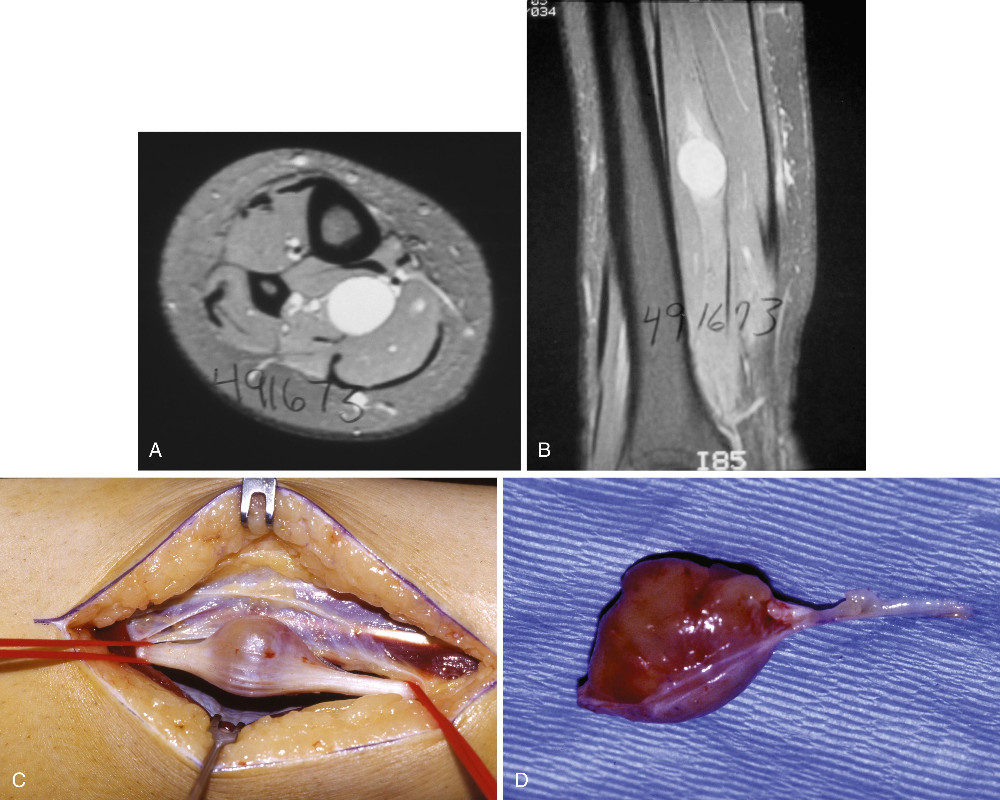 FIGURE 87.1, CT scan (A) and MRI (B) clearly identify neurilemmoma in a 40-year-old man with positive Tinel sign. Note fullness in posterior soft tissues. Gross specimen: unsectioned (C) and sectioned (D) . Microscopically, mass was neurilemmoma. Although they are nerve sheath tumors, some neurilemmomas cannot be removed without excision of nerve branch.