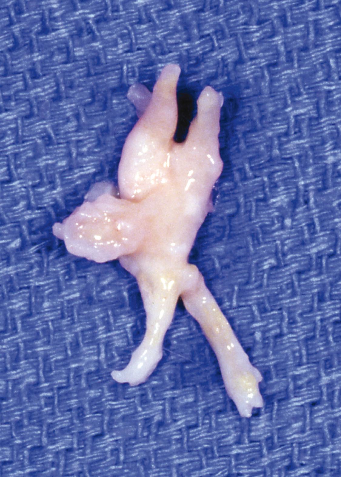 FIGURE 87.11, Common digital nerve with two proper digital branches and neuroma at their junction. SEE TECHNIQUE 87.4 .