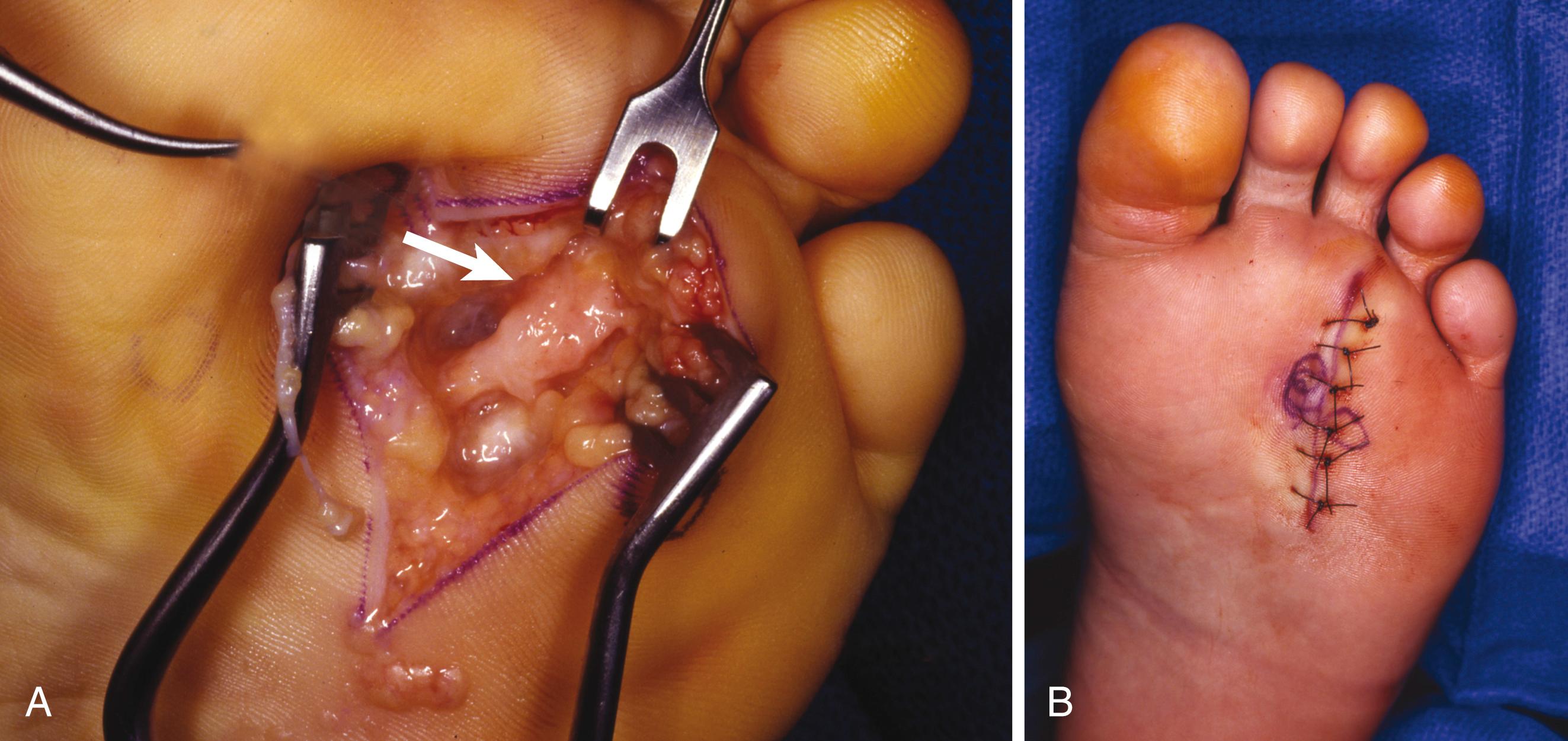 FIGURE 87.12, Interdigital neuroma. A, Plantar incision for “recurrent” interdigital neuroma with communicating nerve entering neuroma (arrow) . B, Closure after neuroma excision. SEE TECHNIQUE 87.5 .