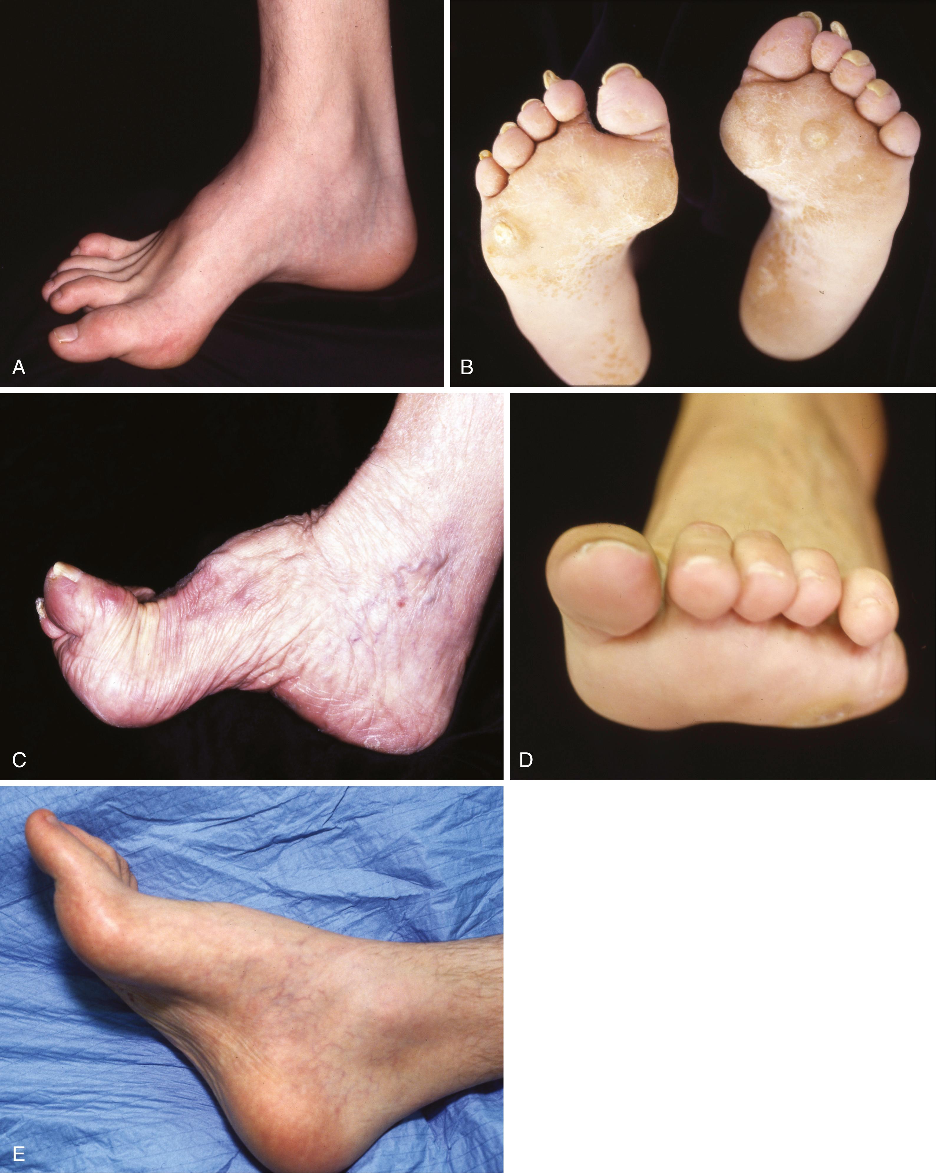 FIGURE 87.13, A, Mild cavus deformity and clawing of toes in patient in whom no cause could be found. B, Calluses beneath metatarsal heads are most common symptom prompting orthopaedic consultation. C, Marked forefoot equinus and resulting dorsal prominence of tarsus in patient with residual poliomyelitis deformity. D, Forefoot is pronated in relation to hindfoot during weight bearing; note clawing of toes. E, Shortening of medial column of foot.