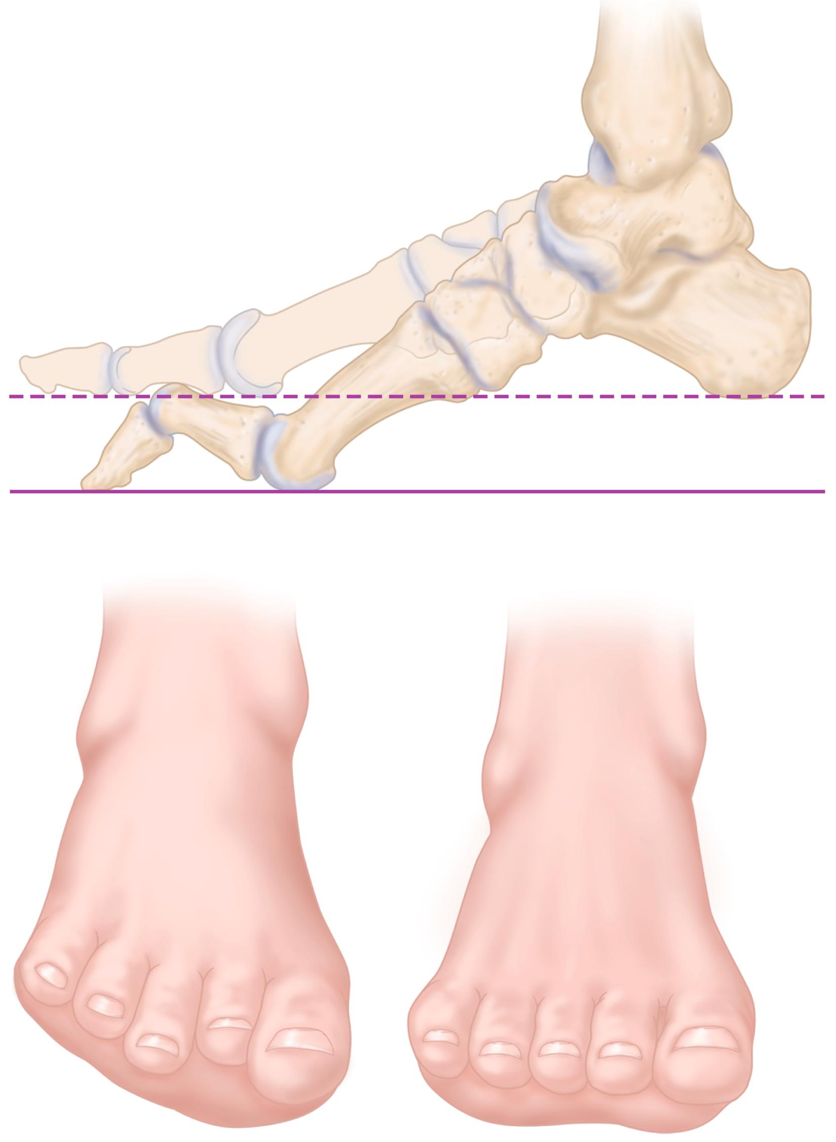 FIGURE 87.14, Lateral and frontal view of plantarflexed first ray as seen in Charcot-Marie-Tooth disease as compared with normal.