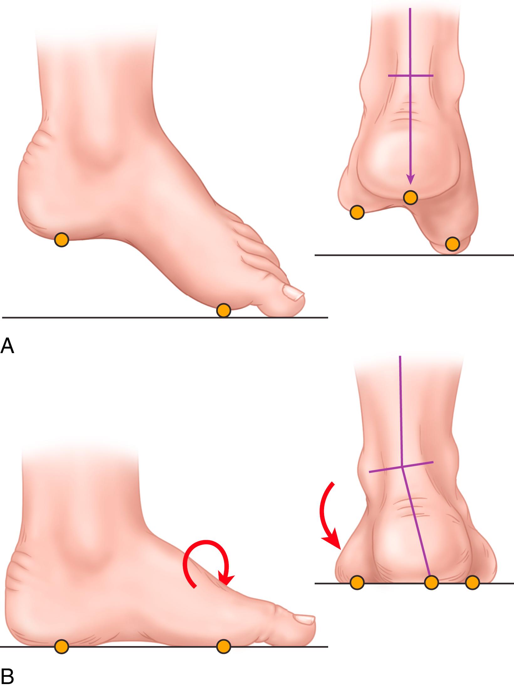 FIGURE 87.15, A and B, When plantarflexed, first ray strikes the ground (A) , heel is forced into varus (B) .