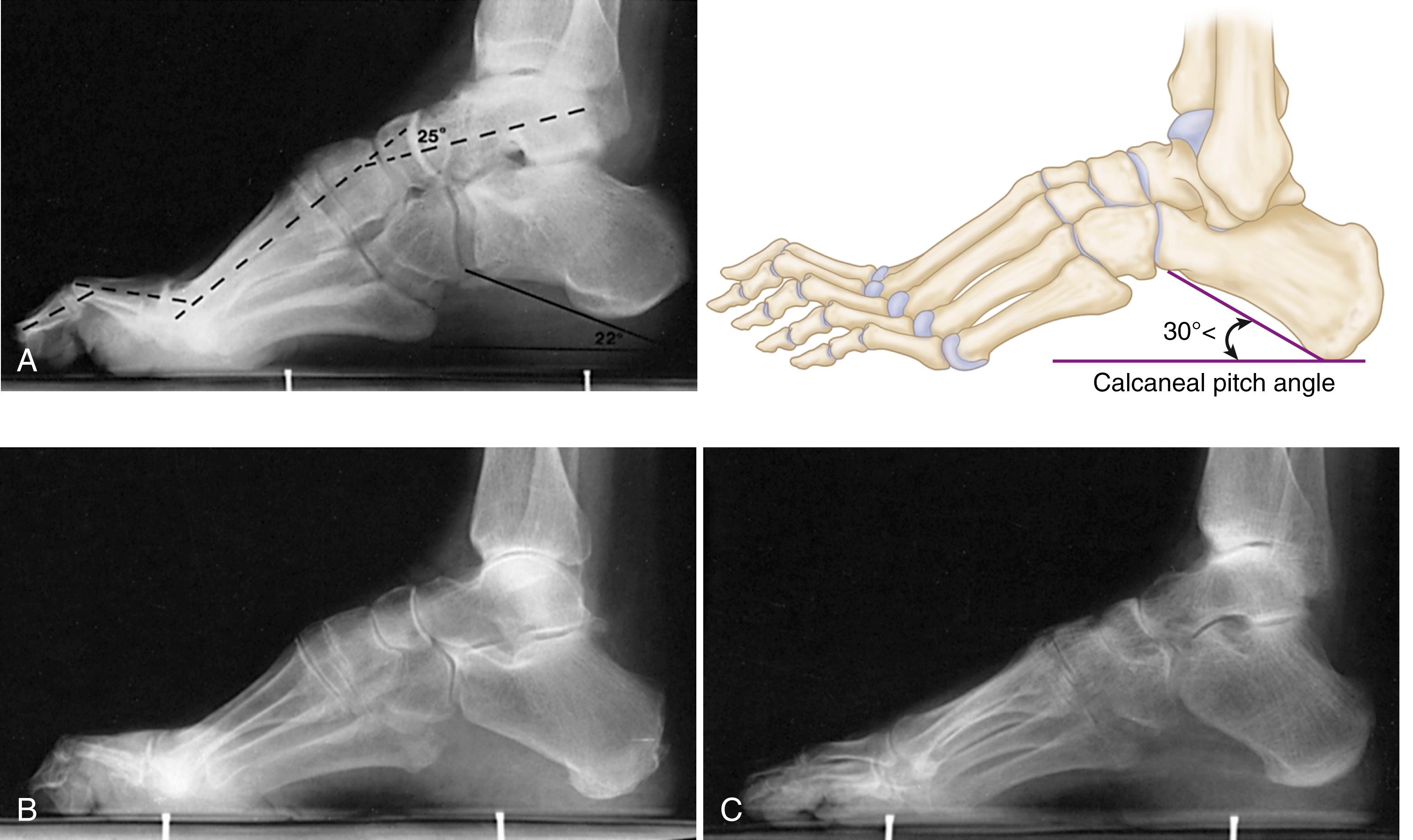 FIGURE 87.16, A, Normal calcaneal pitch, but forefoot equinus in patient with Charcot-Marie-Tooth disease (left). Calcaneal pitch angle measures degree of calcaneus deformity (right). B and C, Calcaneal pitch in idiopathic (B) and postpoliomyelitis (C) deformities.