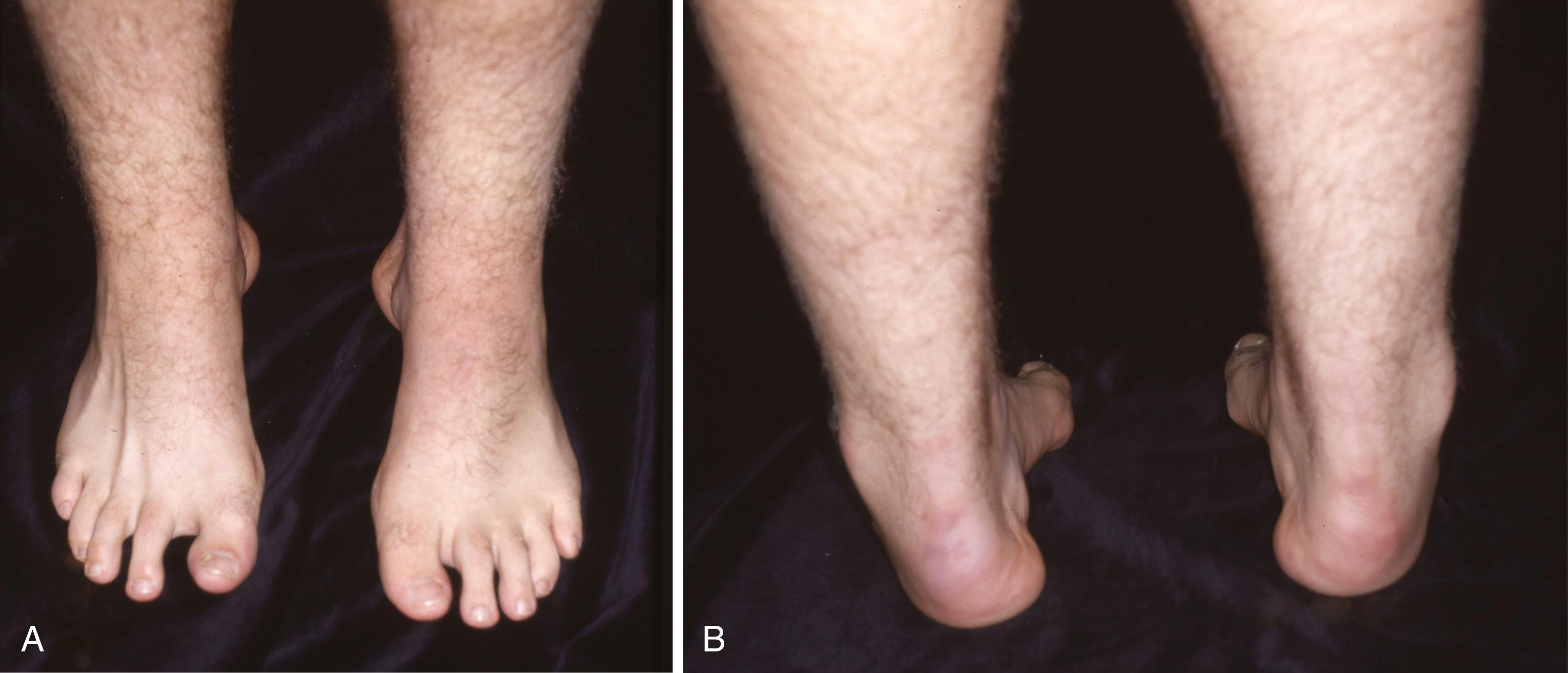 FIGURE 87.17, A and B, Fifteen-year-old boy with “idiopathic” pes cavus diagnosed after extensive neurologic evaluation.