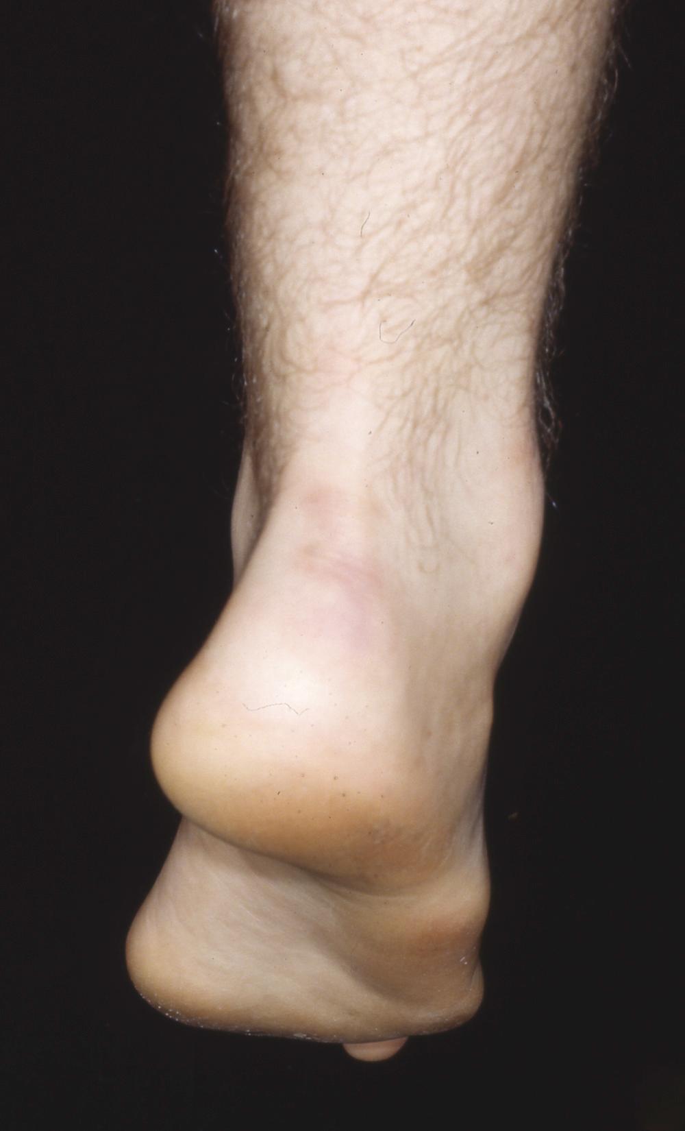 FIGURE 87.18, Eighteen-year-old man with Charcot-Marie-Tooth disease with fixed hindfoot varus, marked forefoot equinus, plantarflexed first ray, forefoot pronation during weight bearing, tight plantar fascia, and contracted Achilles tendon but no palpable contraction of peroneus longus.