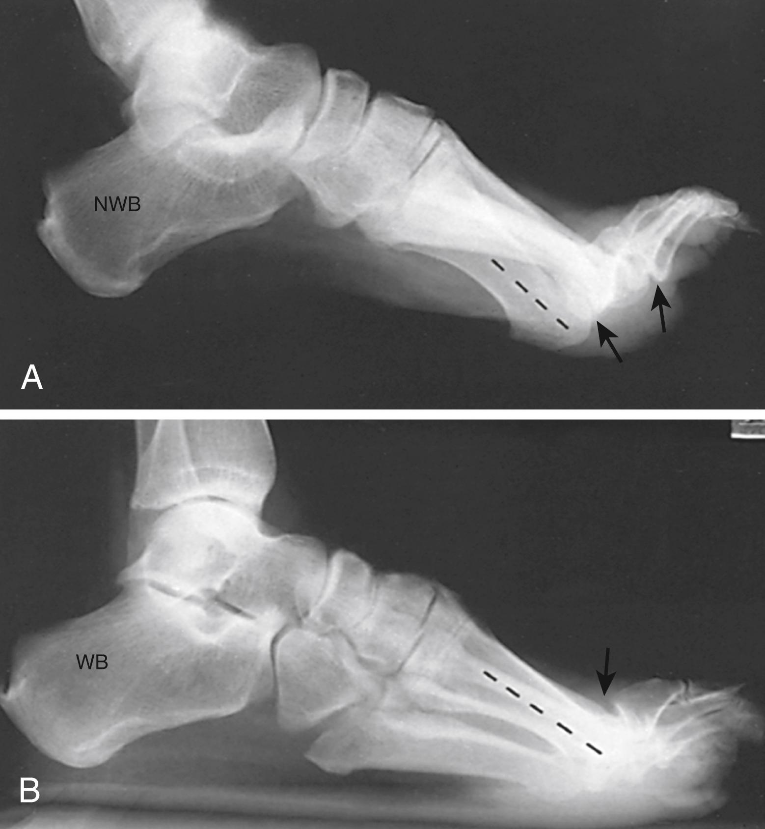 FIGURE 87.19, A, Non–weight-bearing view of cavus and claw toe deformities in patient with Charcot-Marie-Tooth disease. B, On weight-bearing view, plantarflexion of first ray is less noticeable but clawed hallux remains, indicating fixed extension contracture at first metatarsophalangeal joint.