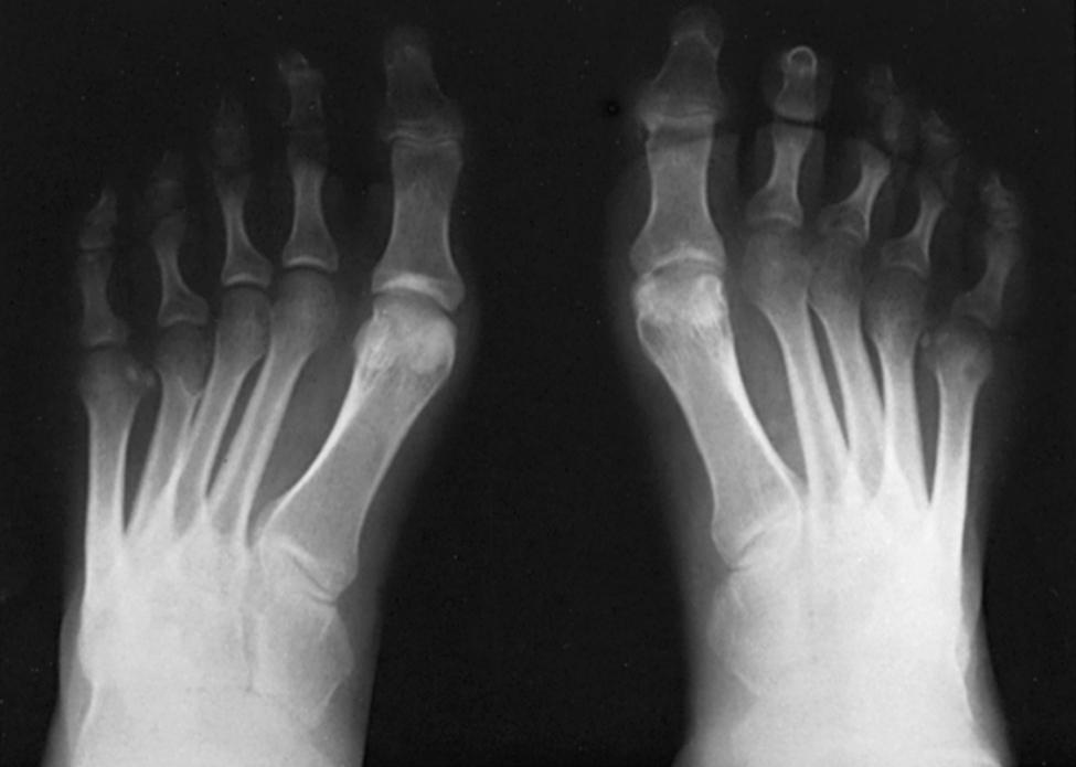 FIGURE 87.20, Weight-bearing anteroposterior view of cavus foot in patient with Charcot-Marie-Tooth disease; note forefoot adduction and supination. Radiographic metatarsus adductus is partially positional and partially true adductus.