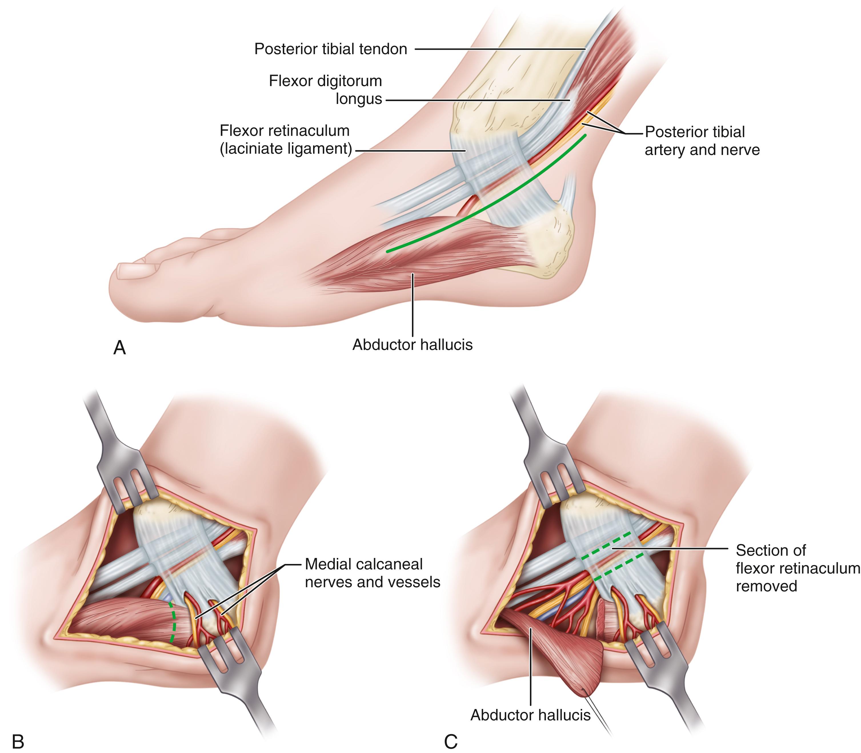 FIGURE 87.2, Tarsal tunnel release. A, Skin incision. B, Note branches of medial calcaneal nerve and artery penetrating retinaculum. Dashed line indicates incision for reflecting abductor hallucis muscle. C, Abductor hallucis is reflected plantarward, and section of flexor retinaculum to be removed is outlined. SEE TECHNIQUE 87.1 .