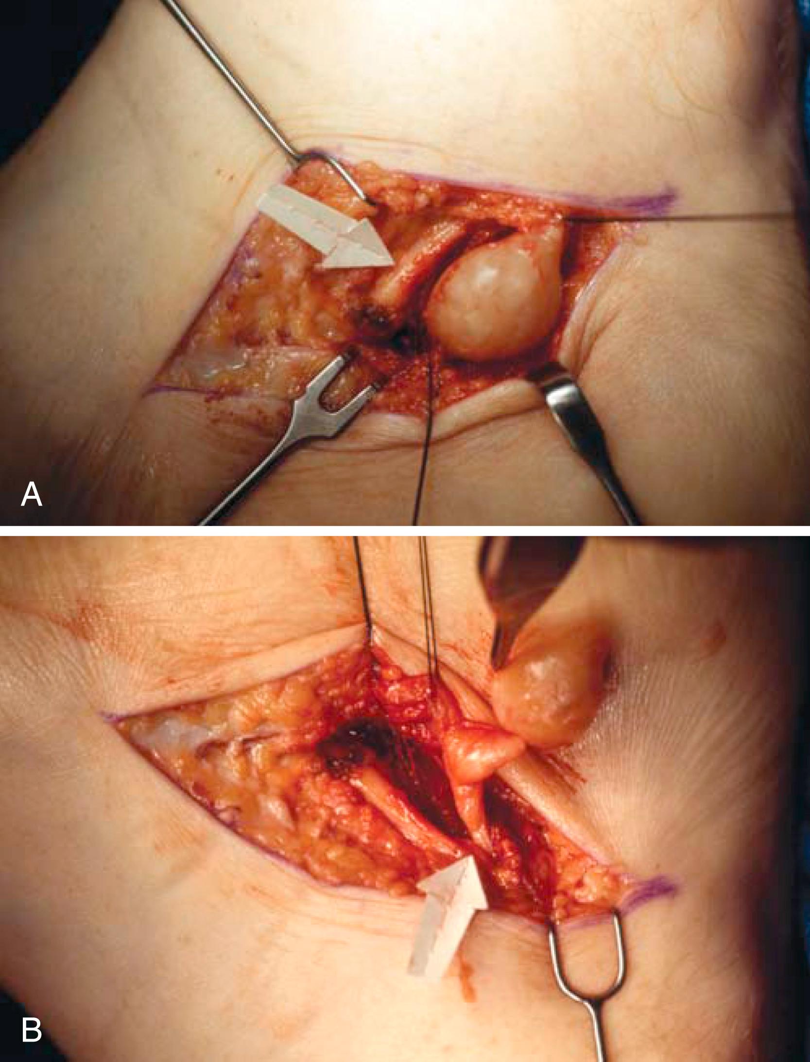 FIGURE 87.3, A and B, Arrow points to lateral plantar nerve. Tumor involves medial calcaneal branch of nerve. Tumor was resectable, leaving most of this branch intact. SEE TECHNIQUE 87.1 .