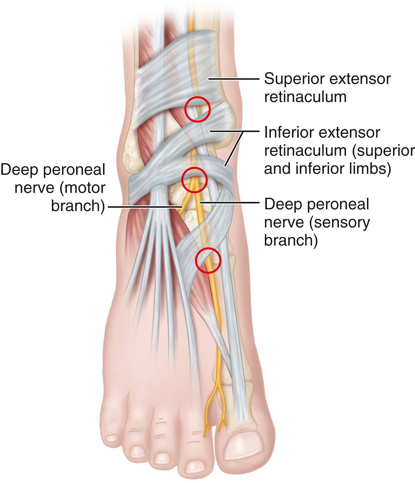 FIGURE 87.5, Deep peroneal nerve entrapment. Circles denote areas of impingement.