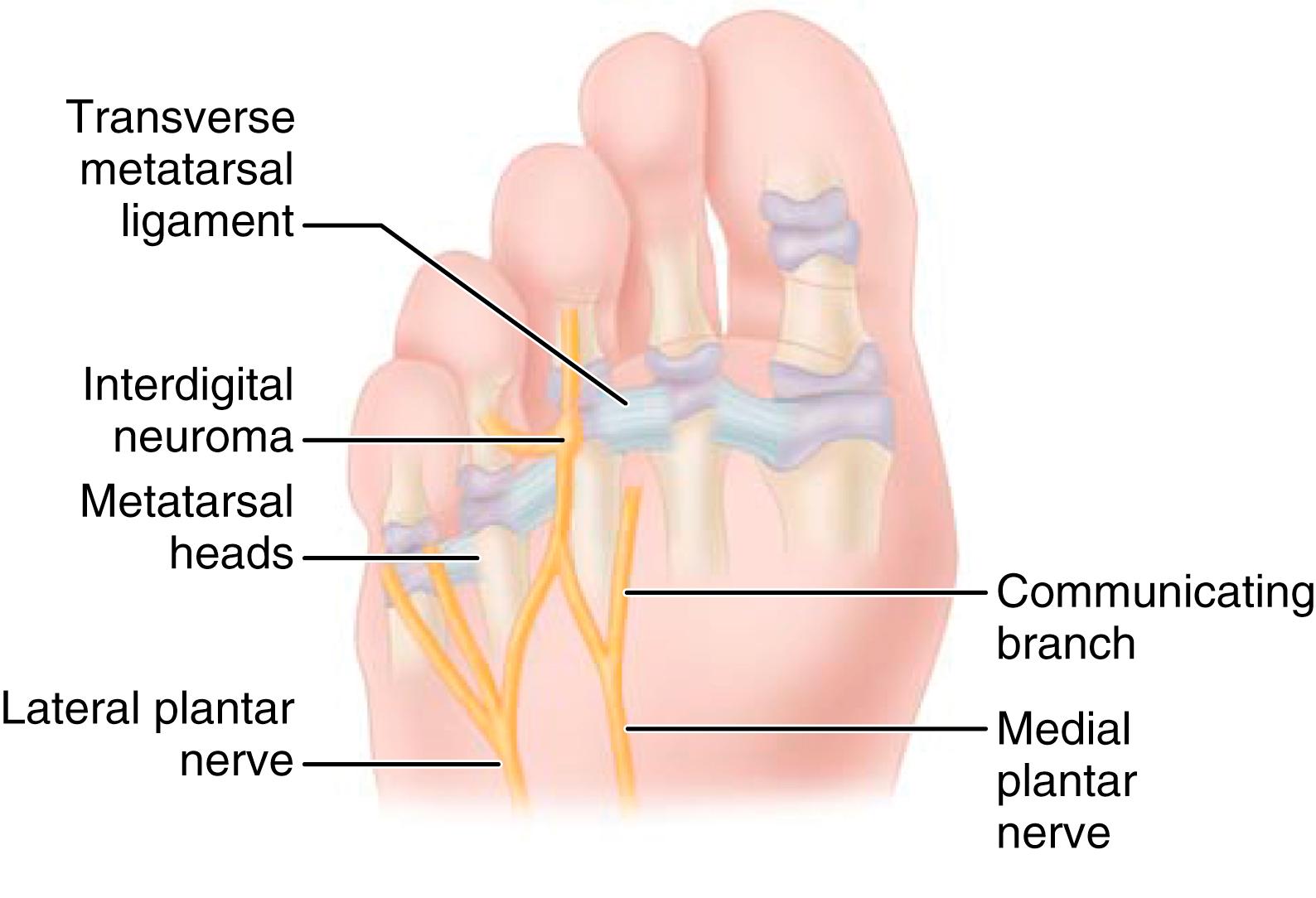 FIGURE 87.6, Most common anatomic location of interdigital neuroma.