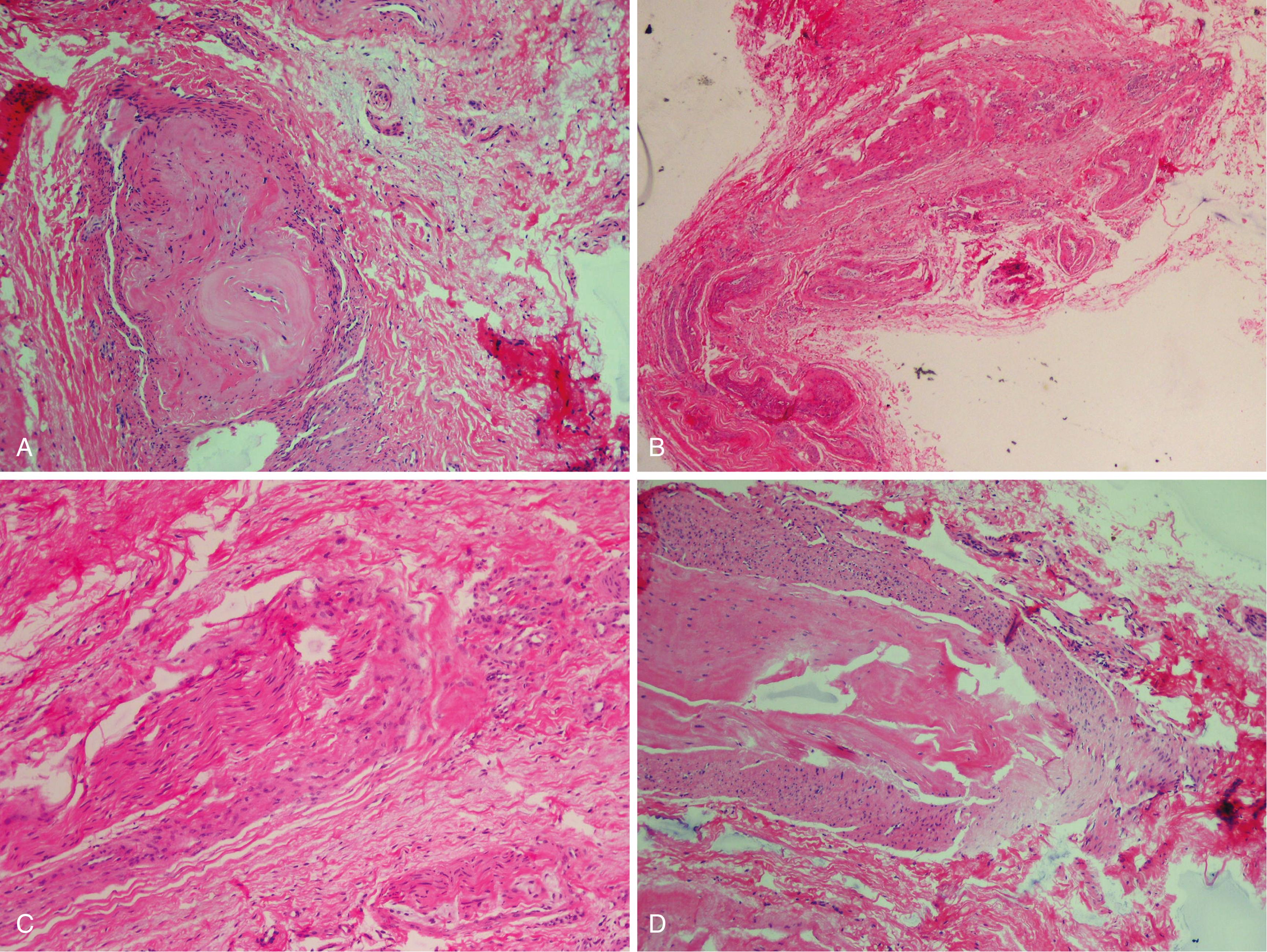 FIGURE 87.7, Pathologic findings of interdigital neuroma. A, Interdigital nerve is greatly thickened by perineural fibrous tissue (hematoxylin and eosin stain). B, Vessels in region often show degenerative changes such as fraying and duplication of internal elastic lamina (Verhoeff-van Gieson stain). C, Some axons are missing, and others show degenerative changes (Bielschowsky stain). D, Small bursa may be found in region (hematoxylin and eosin stain).