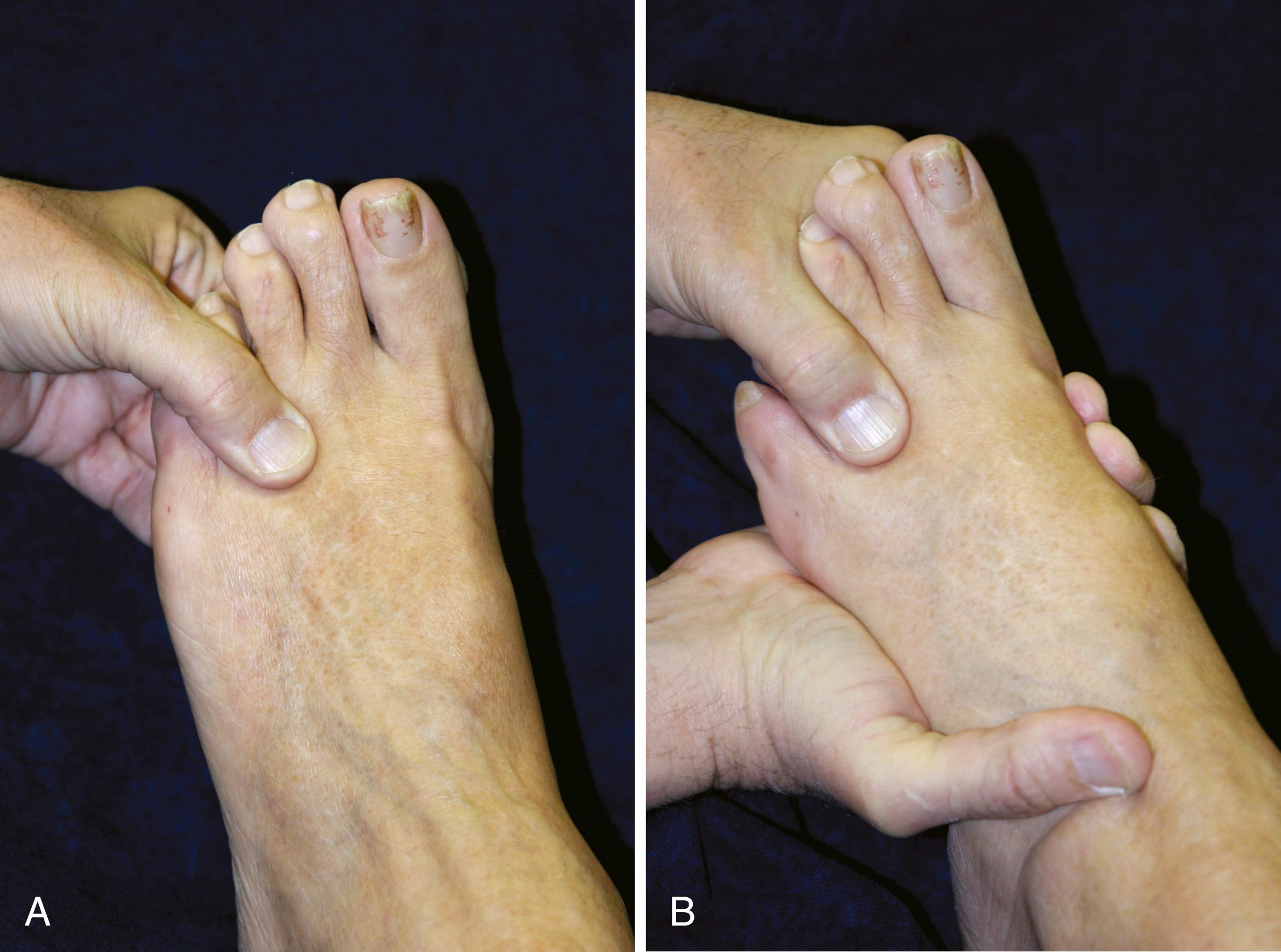 FIGURE 87.8, A, Digital manipulation with pressure applied just proximal to metatarsal heads by squeezing forefoot between index finger and thumb. B, Simultaneous compression of forefoot with one hand and compression of web space with two fingers of opposite hand.