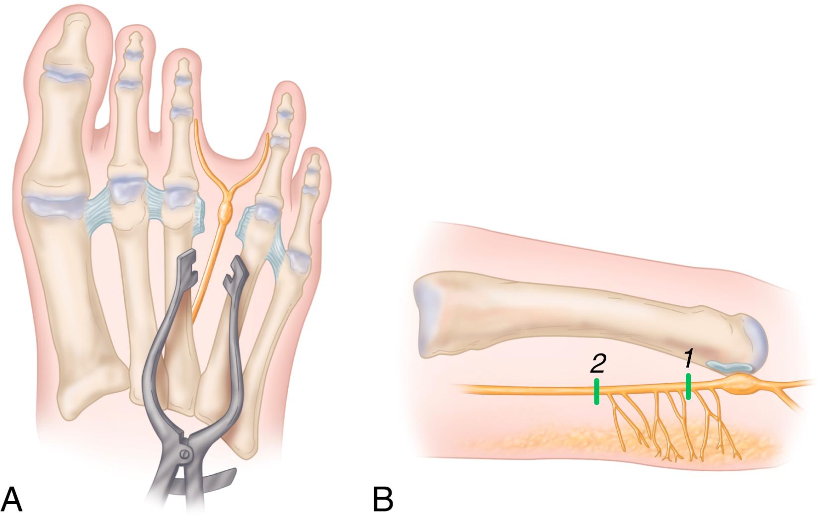 FIGURE 87.9, A, Lamina spreader used to expose neuroma. B, Lateral view of plantar branches of digital nerve. 1, Previously recommended level of neurectomy; 2, currently recommended level of neurectomy (3 cm proximal to ligament) to avoid plantarly directed nerve branches. SEE TECHNIQUE 87.4 .