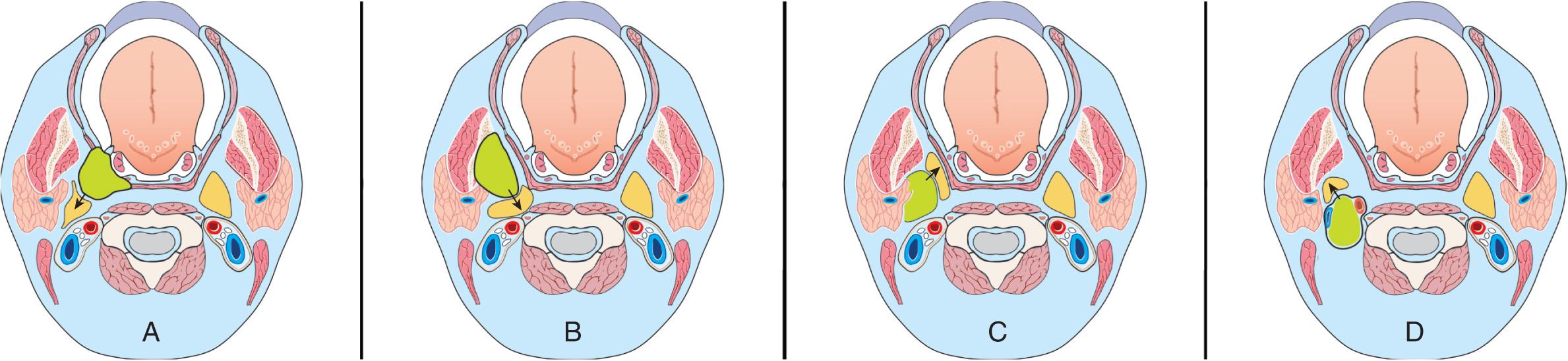 Figure 14.13, The pattern of displacement of parapharyngeal space (PPS) fat by tumors of the surrounding spaces allows identification of the origin of tumors in relation to the PPS. A , Pharyngeal mucosal space (PMS). B , Masticator space (MS). C , Parotid space (PS). D , Carotid space (CS).