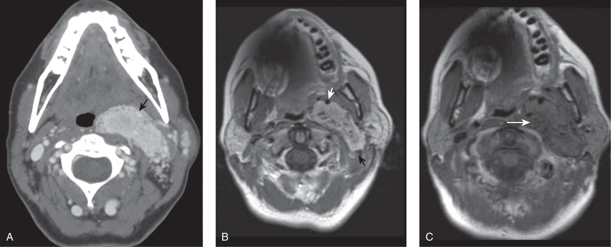 Figure 14.14, A , A contrast-enhanced axial CT scan shows a densely enhancing mass in the left carotid space that displaces the internal carotid artery ( arrow ) anteromedially. The internal jugular vein is not visible on this section, because it is effaced by the lesion. B , An axial postcontrast T1-weighted magnetic resonance imaging scan shows intense enhancement of the mass. The mass displaces the internal jugular vein posterolaterally ( black arrow ) and the internal carotid artery anteromedially ( white arrow ). C , Multiple low-signal flow voids ( white arrow ) on T1-weighted magnetic resonance imaging are a typical characteristic of a paraganglioma.