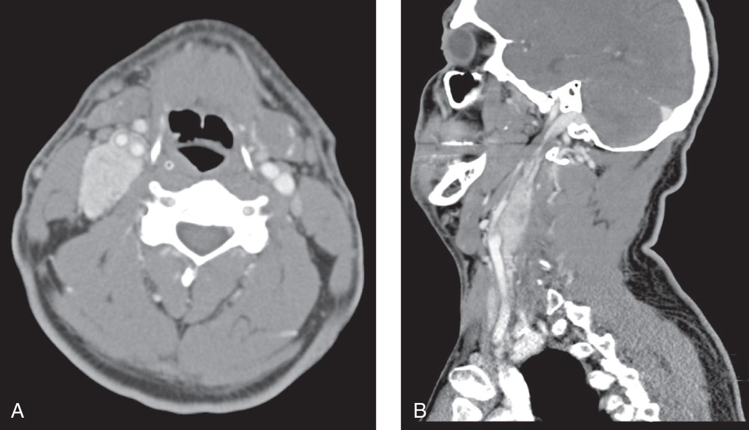 Figure 14.15, Contrast-enhanced computed tomography scan of a patient with vagal paraganglioma in axial ( A ) and sagittal ( B ) views. Note the contrast enhancement and the location of the tumor posterior to the carotid artery and jugular vein on the axial view and a spindle-shaped tumor posterior to the carotid sheath in the sagittal view.