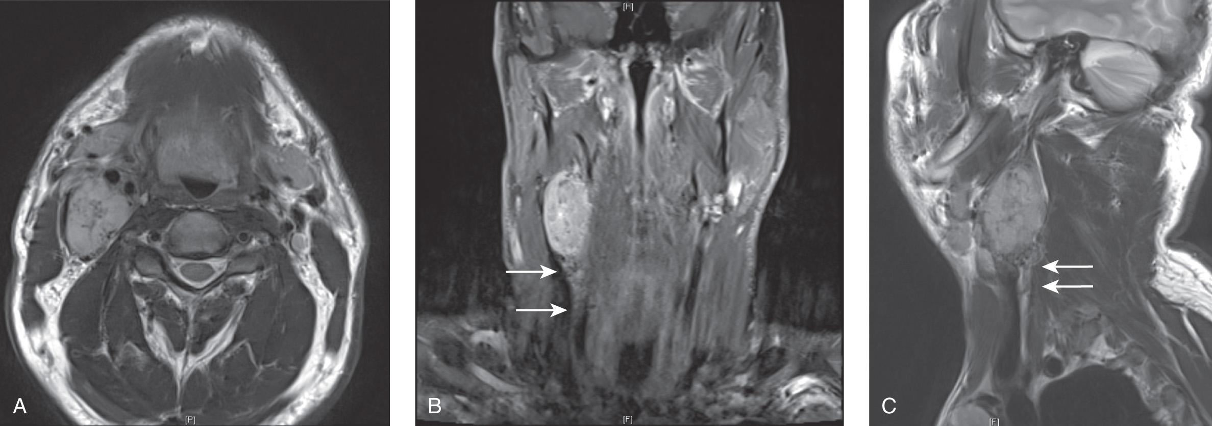 Figure 14.16, Magnetic resonance imaging scans in T2-weighted axial view ( A ), postcontrast T1-weighted coronal view ( B ), and postcontrast T1-weighted sagittal view ( C ) showing a vagal paraganglioma. Note contrast enhancement and flow voids, as well as “rat tail” appearance on coronal and sagittal views, characteristic of a paraganglioma of lower cranial nerves ( arrows ).