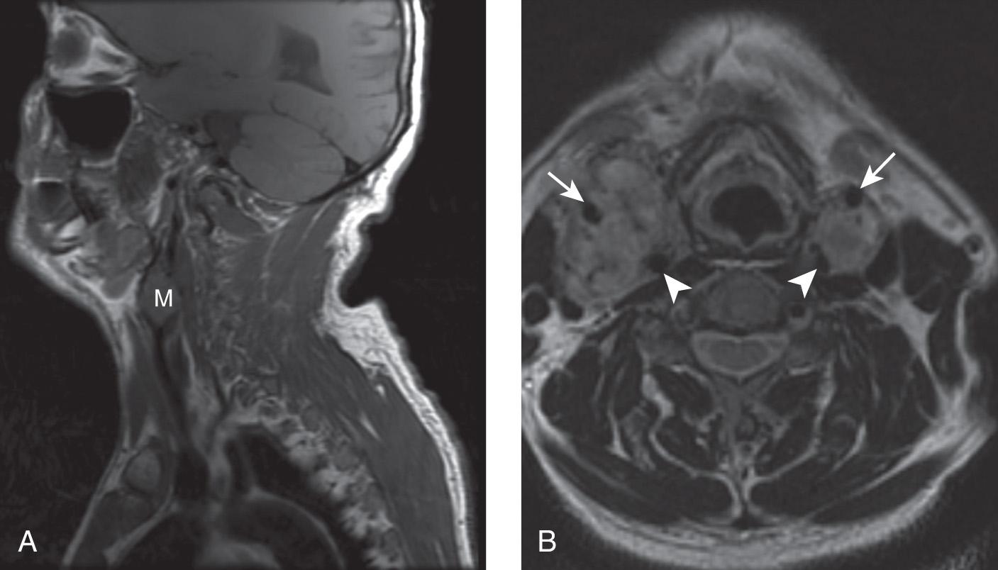 Figure 14.17, Sagittal precontrast T1-weighted magnetic resonance imaging (MRI) shows a mass (M) located in the carotid bifurcation splaying the internal carotid artery posteriorly and the external carotid artery anteriorly ( A ). A T2-weighted MRI scan of the same patient demonstrates bilateral carotid body tumors splaying the internal carotid artery ( arrowheads ) posteriorly and the external carotid artery ( arrows ) anteriorly ( B ).