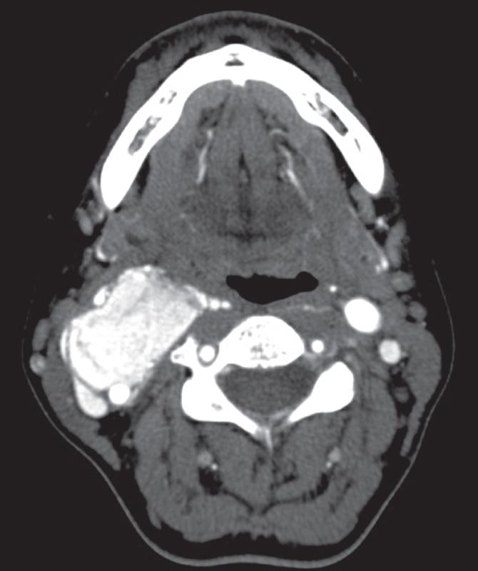 Figure 14.18, An axial view of a contrast-enhanced computed tomography scan of the neck showing a Shamblin type 1 carotid body tumor on the right-hand side.