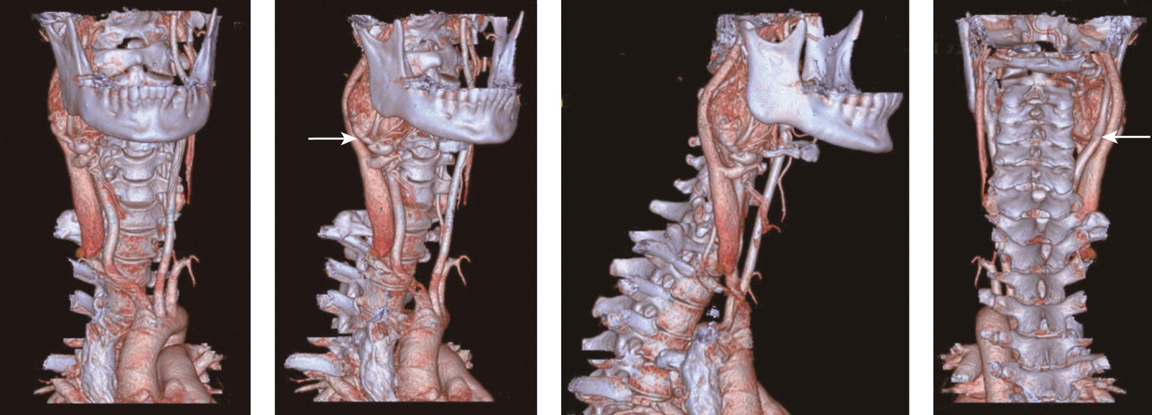 Figure 14.19, Three-dimensional reconstructions of computed tomography angiograms showing a shambling type 1 carotid body tumor on the right-hand side in anterior, lateral, and posterior view showing the relationship of external and internal carotid arteries to the tumor ( arrows ).