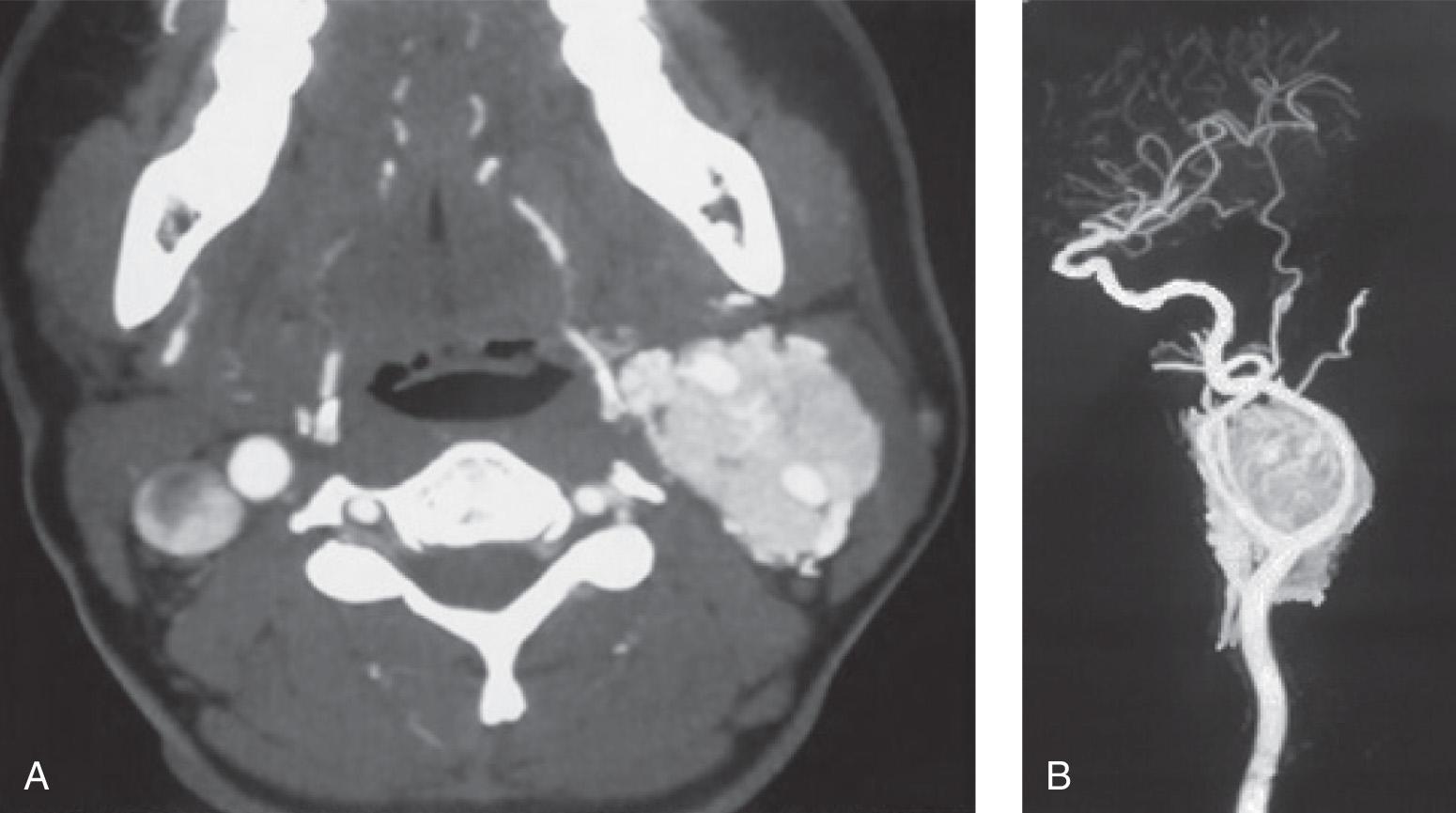 Figure 14.20, An axial view of a contrast-enhanced computed tomography (CT) scan ( A ) showing a Shamblin type 2 carotid body tumor. CT angiography ( B ) clearly shows the location and relationship of the carotid arteries to the tumor.