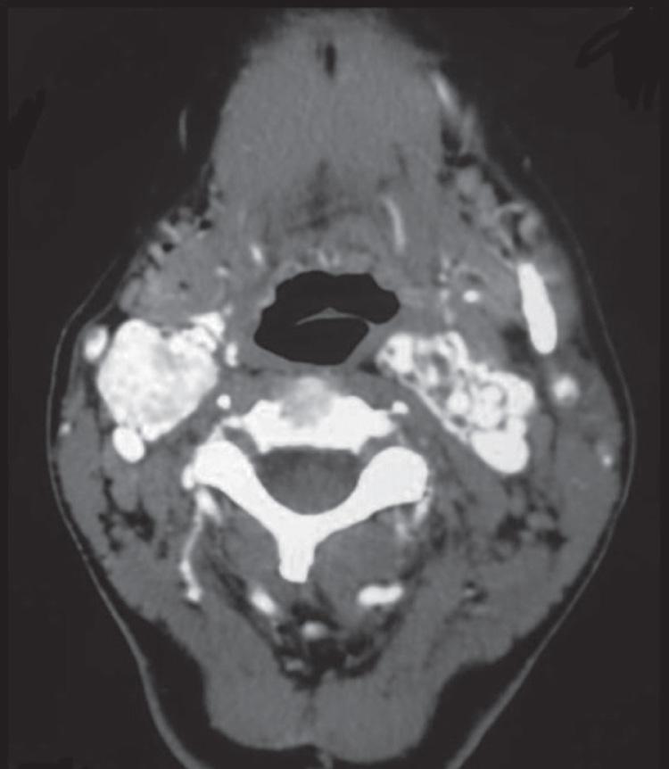 Figure 14.21, An axial view of a contrast-enhanced computed tomography scan of the neck showing bilateral carotid body tumors.