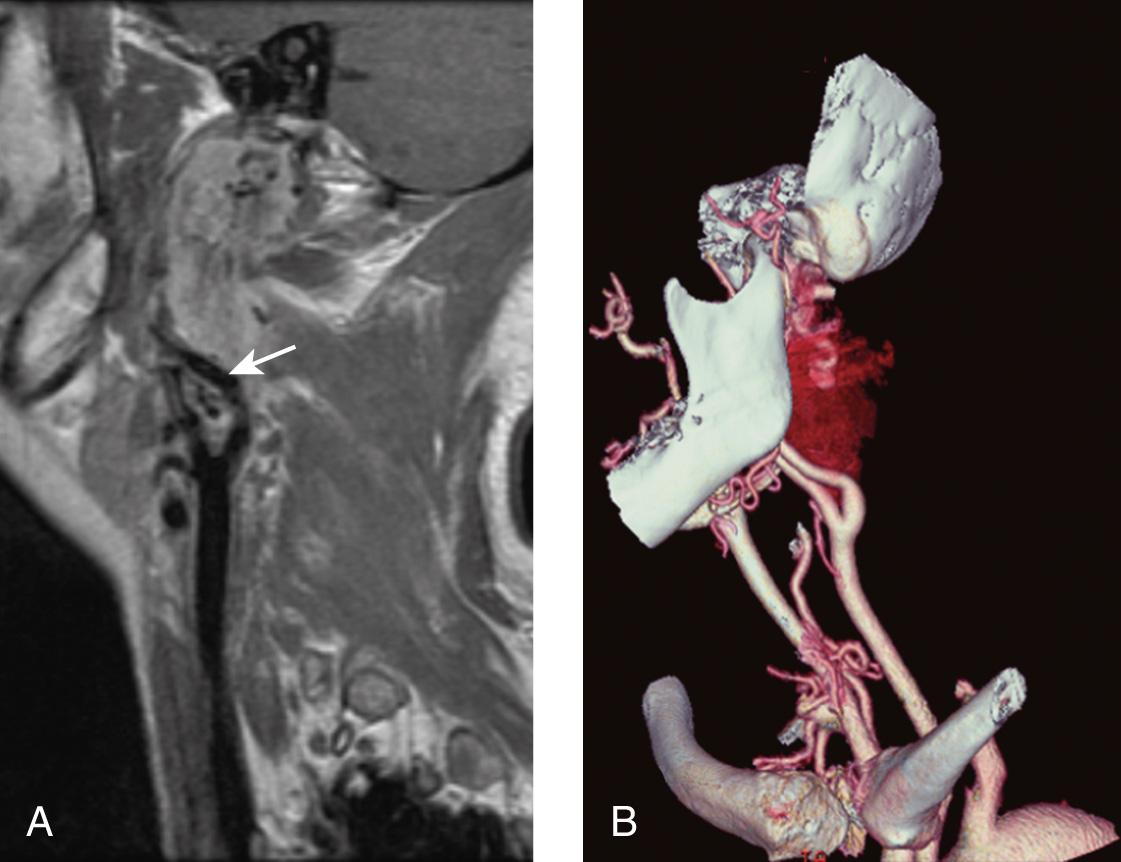 Figure 14.22, A sagittal postcontrast T1-weighted magnetic resonance imaging scan shows a heterogeneously enhancing carotid space mass displacing both the internal carotid artery ( arrow ) and external carotid artery anteriorly and with cephalad extension into the jugular foramen ( arrow ) ( A ). An oblique computed tomography angiogram three-dimensional reconstruction nicely illustrates the relationship to the surrounding structures ( B ).