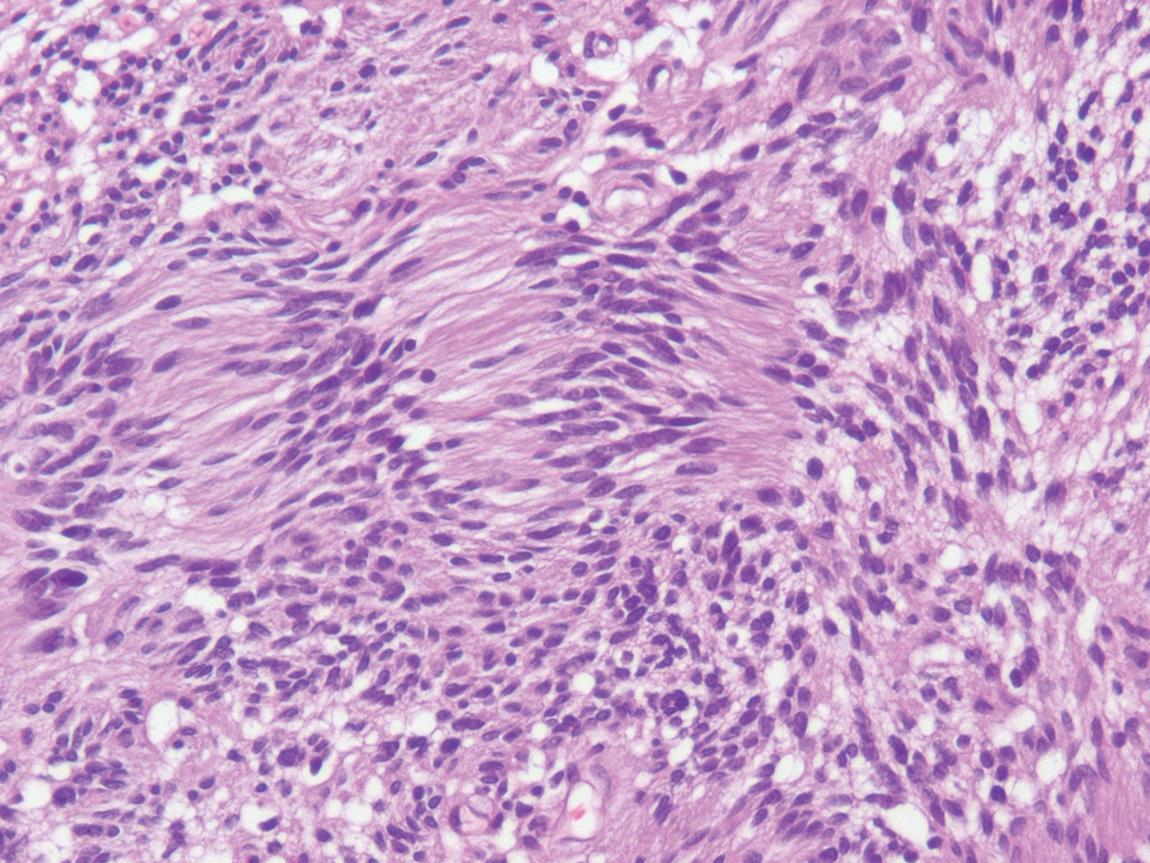 Figure 14.4, The histologic appearance of a schwannoma (hematoxylin and eosin stain). Palisading nuclei form Verocay bodies in the cellular Antoni A areas. The looser, myxoid areas are referred to as Antoni B areas. Prominent thick-walled blood vessels are another common histologic feature.