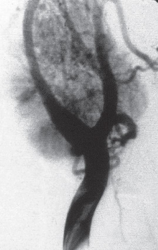 Figure 14.24, A direct angiogram through the right common carotid artery shows feeding blood vessels to a vagal paraganglioma.