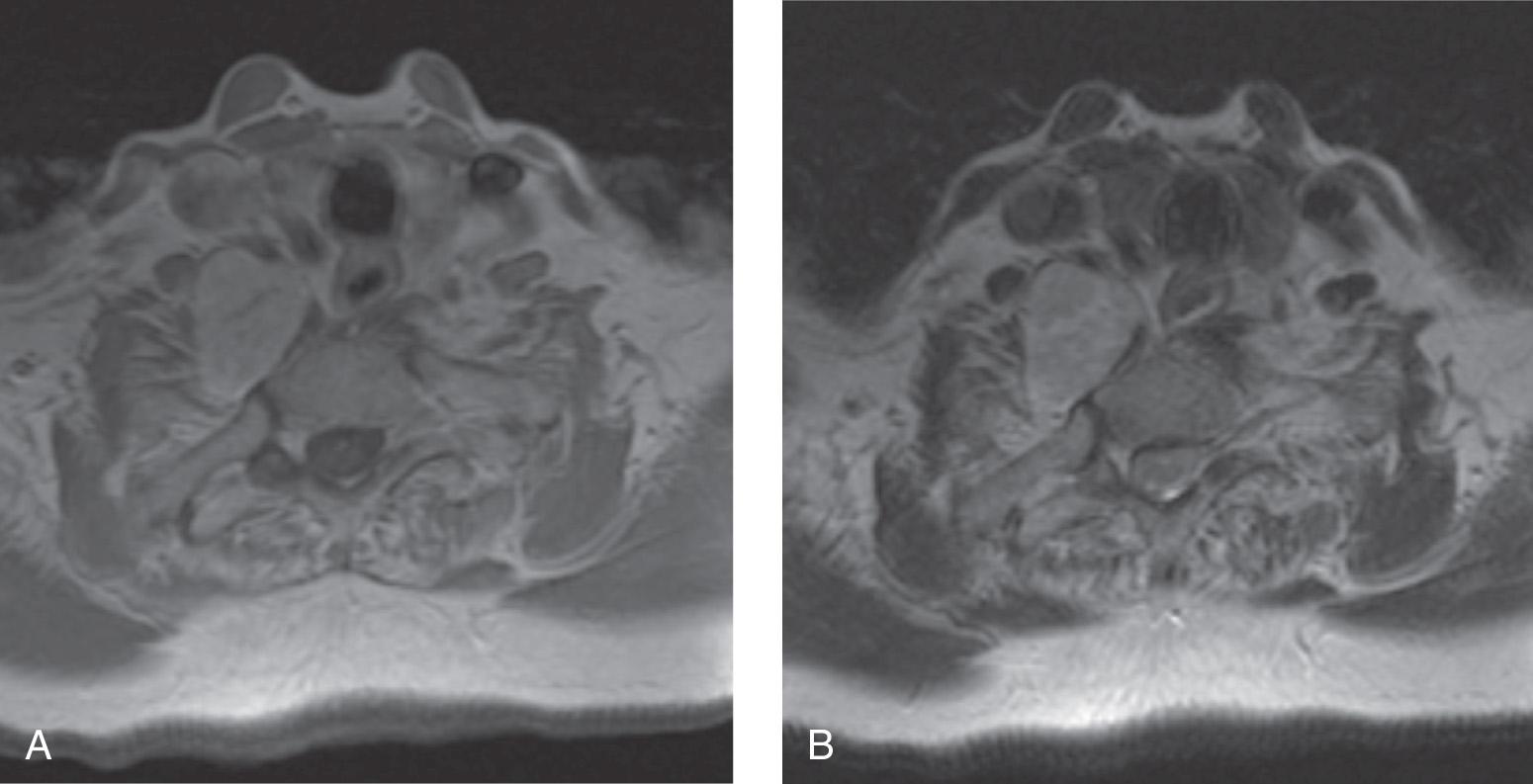 Figure 14.26, A postcontrast T1-weighted axial view of magnetic resonance imaging scan ( A ) showing a contrast enhancing schwannoma posterior to the carotid sheath in the lower part of the neck. On T2-weighted sequence, it is bright ( B ).