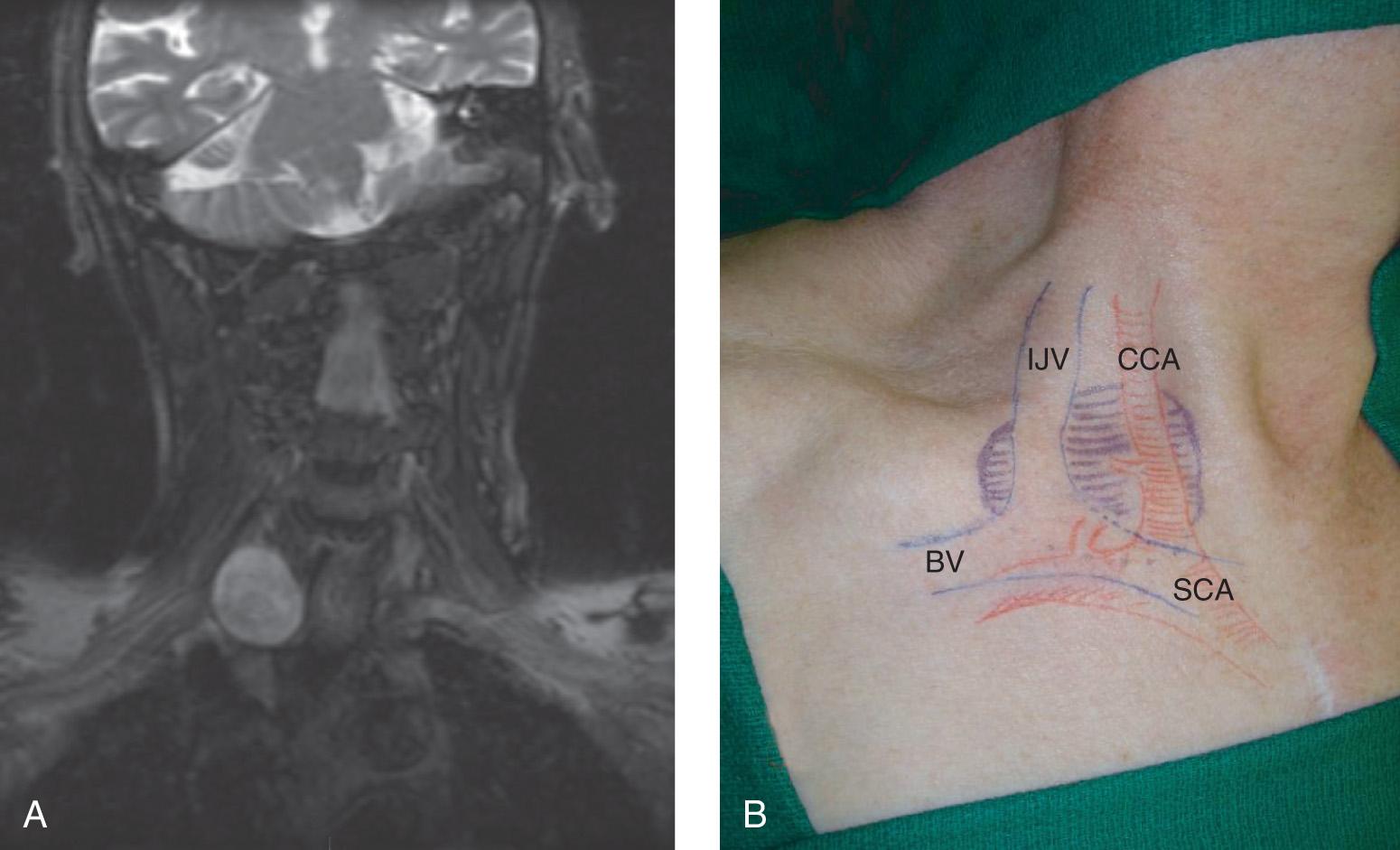 Figure 14.27, A , Coronal view of the magnetic resonance image of the tumor shown in Fig. 14.28 demonstrates a well-circumscribed “round” tumor in the lower part of the neck. B , Outline of the relationship of the tumor to great vessels in the lower part of the neck. BV, Brachial vein; CCA, common carotid artery; IJV, internal jugular vein; SCA, subclavian artery.