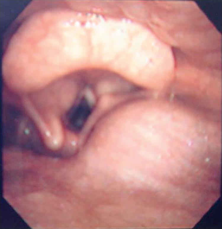 Figure 14.28, Endoscopic view of the hypopharynx showing a submucosal tumor mass of the prevertebral space projecting into the pharynx.