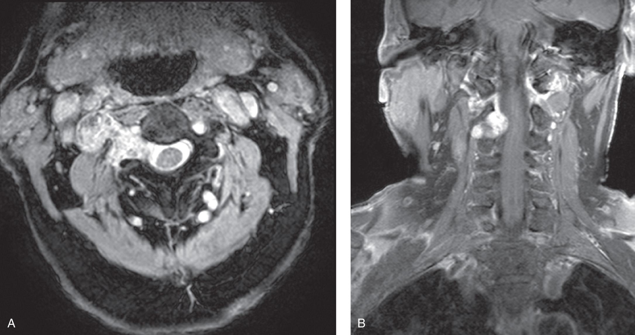 Figure 14.30, An axial T2-weighted magnetic resonance imaging (MRI) scan shows a dumbbell tumor of neurogenic origin with intraspinal extension ( A ). A coronal view of a postcontrast T1-weighted MRI scan clearly shows the intraspinal extension ( B ).