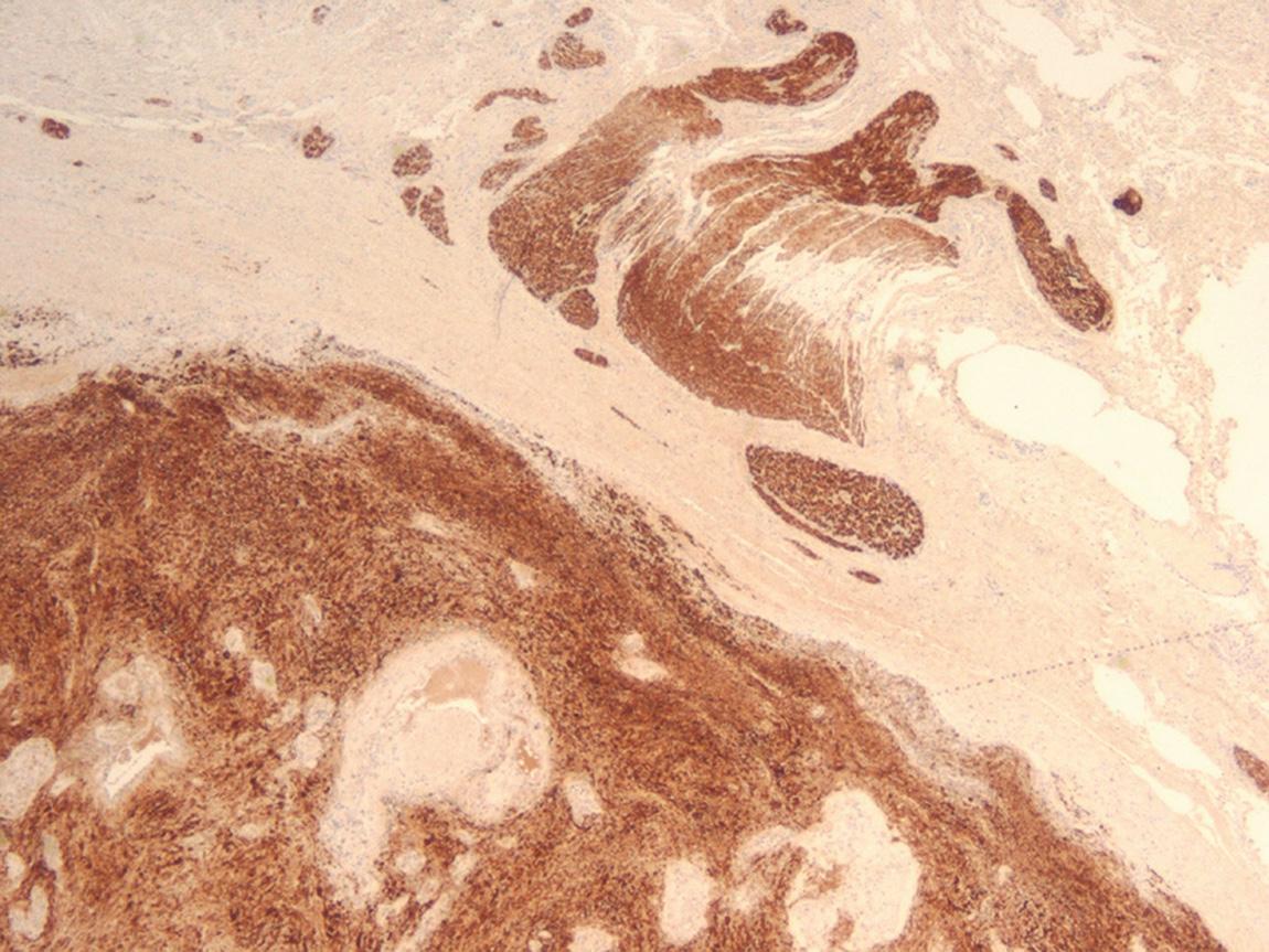 Figure 14.5, An immunohistochemical stain for S-100 protein. Like their normal counterparts, schwannomas are strongly and diffusely immunoreactive for S-100 protein.