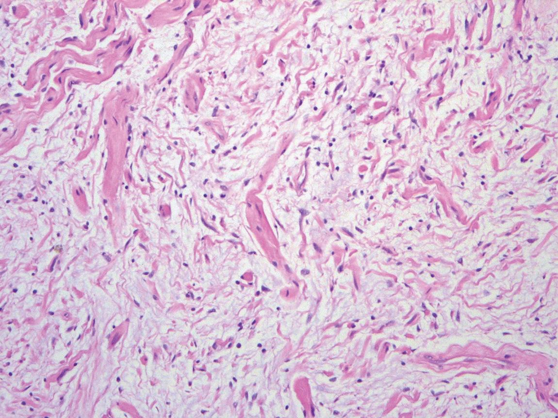 Figure 14.6, The histologic appearance of a neurofibroma (hematoxylin and eosin stain). Histologically, a neurofibroma will have a loosely arranged background of collagen fibrils, which have been likened to “shredded carrots,” with small, uniform nuclei. These tumors are positive for S-100 protein, although not as strongly and diffusely as are schwannomas.