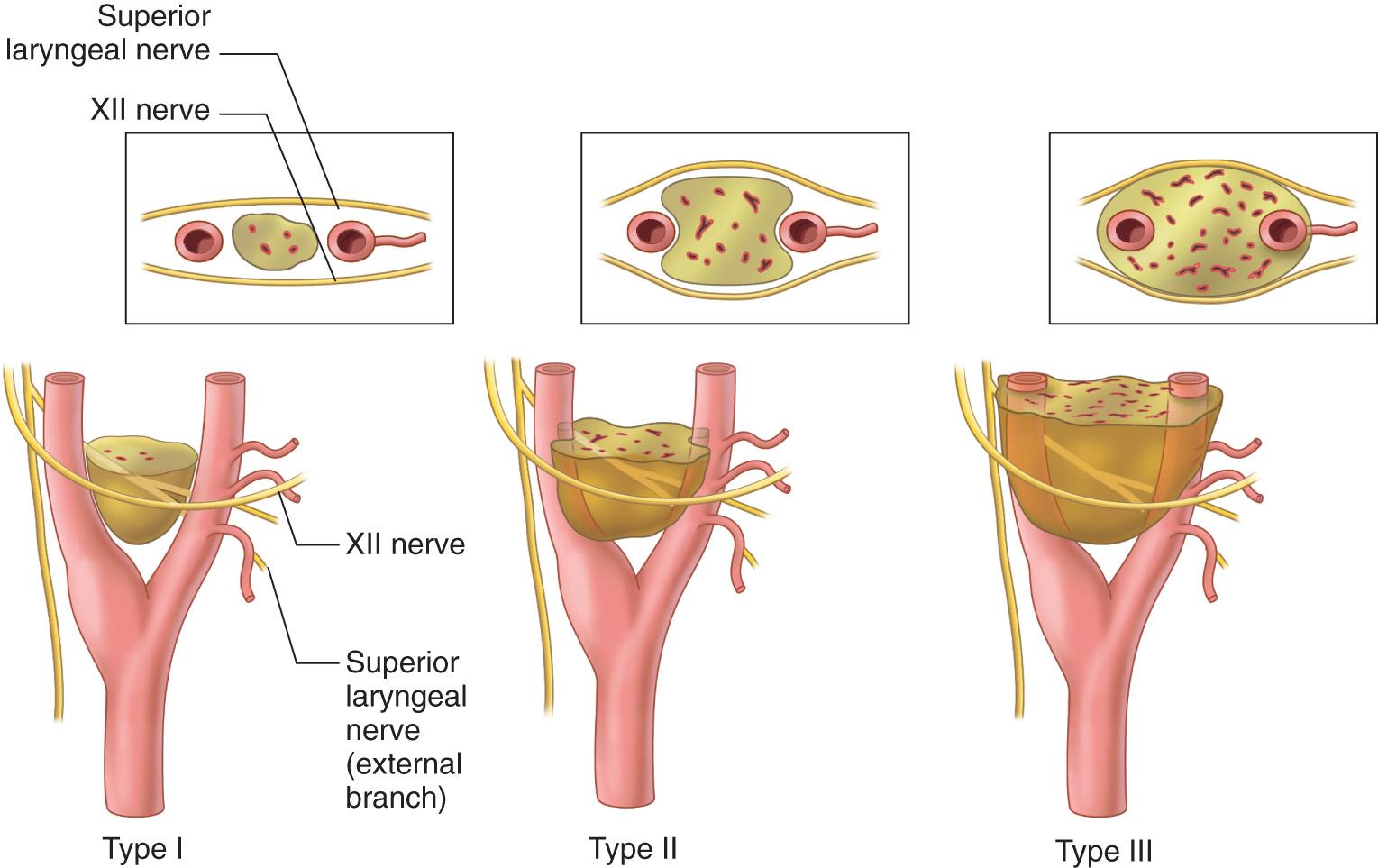 Figure 14.8, Shamblin's classification of carotid body tumors.