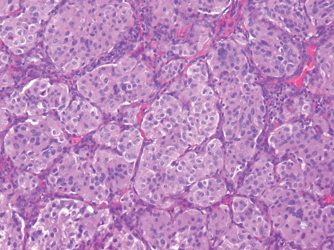 Figure 14.9, A paraganglioma (hematoxylin and eosin stain). Paragangliomas have a characteristic nested, or Zellballen, appearance.