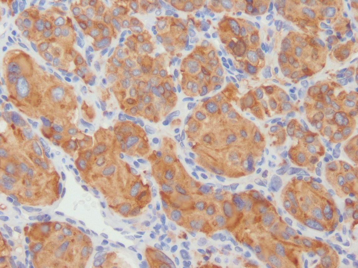 Figure 14.10, Immunohistochemistry for S-100 protein highlights peripheral sustentacular cells in a paraganglioma.