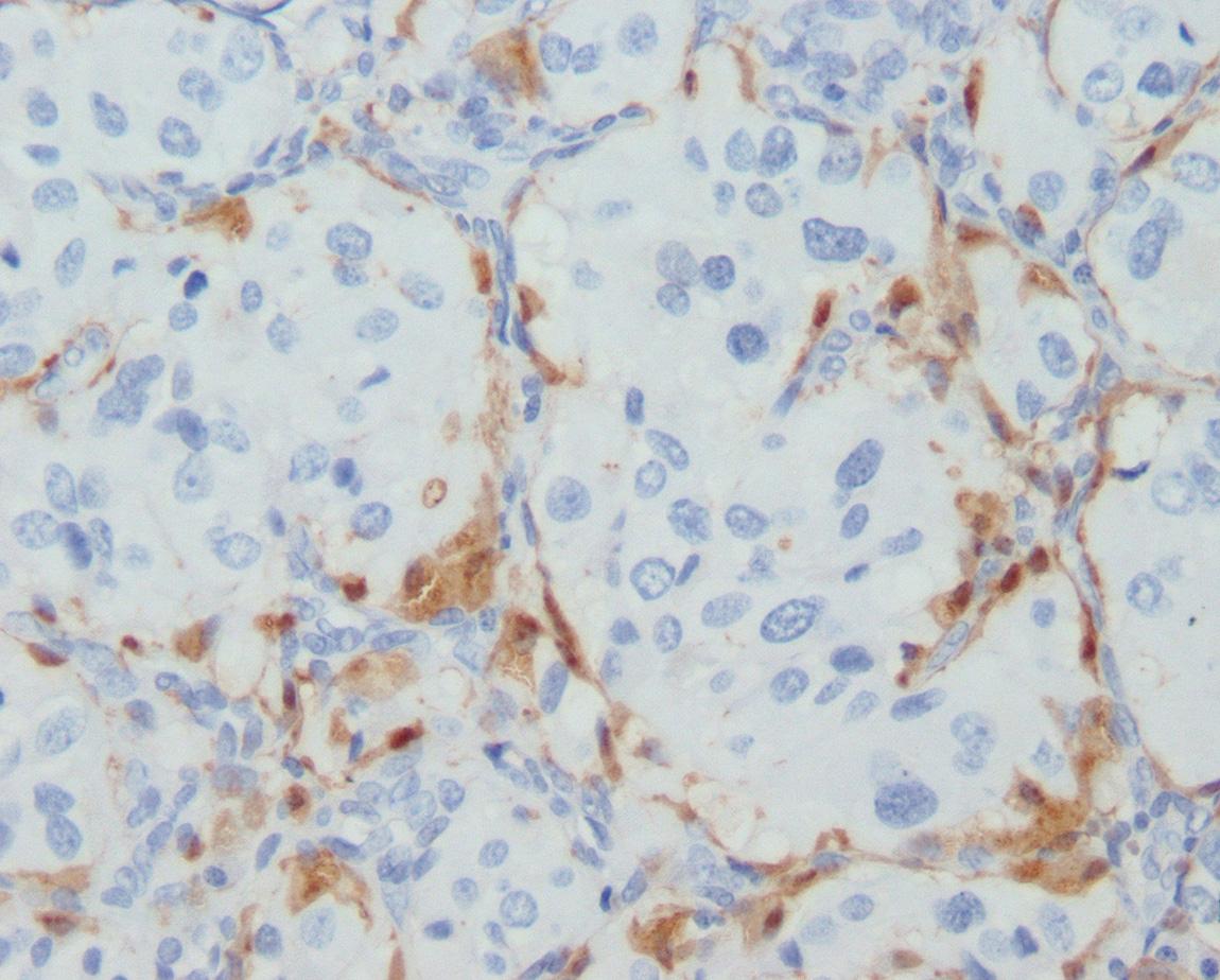 Figure 14.11, Chromogranin labels the cytoplasm of the chief cells, reflecting the presence of neurosecretory granules. Similarly, synaptophysin also will be positive. Cytokeratin, carcinoembryonic antigen (CEA), and calcitonin are negative.