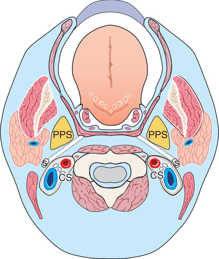 Figure 14.12, Schematic diagram of the normal anatomy of the parapharyngeal space ( PPS ) for correlation with radiographic imaging. The prestyloid space is separated from the poststyloid compartment or carotid space ( CS ) by the tensor-vascular-styloid fascia ( white line ) that extends medially from the styloid process ( S ) to the pharynx and overlies the tensor veli palatini muscle.