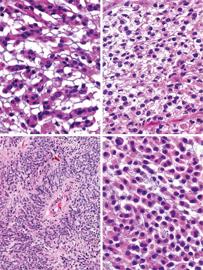 FIGURE 14-11, Meningioma: microscopic features.