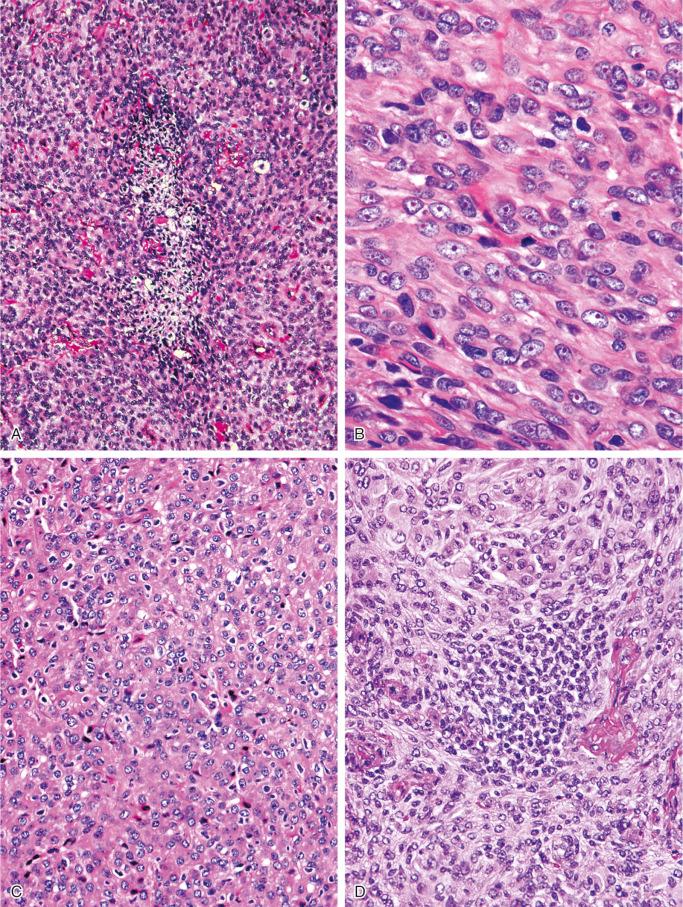 FIGURE 14-12, Meningioma: microscopic features.