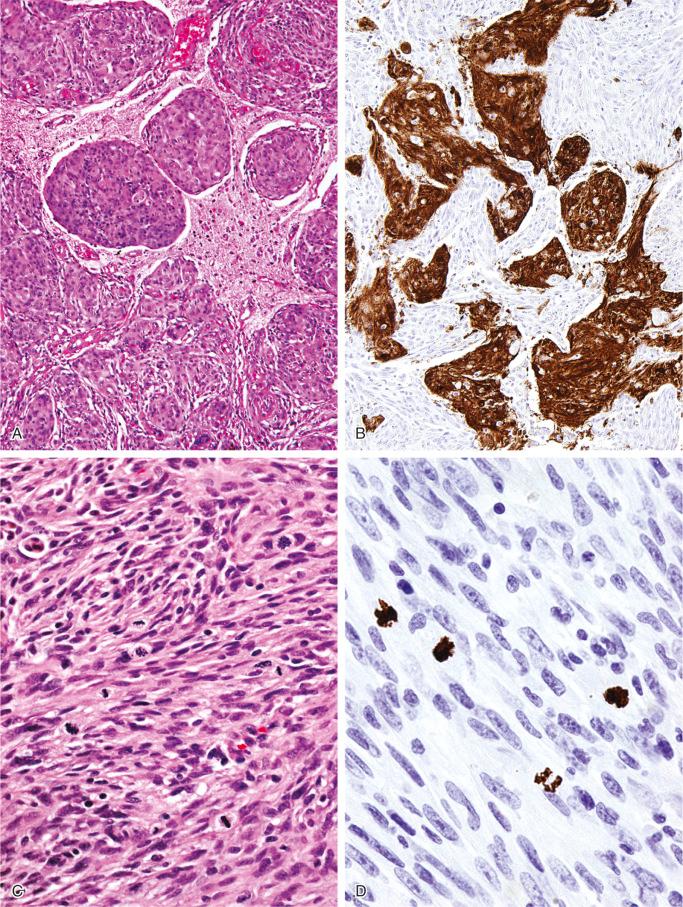 FIGURE 14-13, Meningioma: microscopic features.