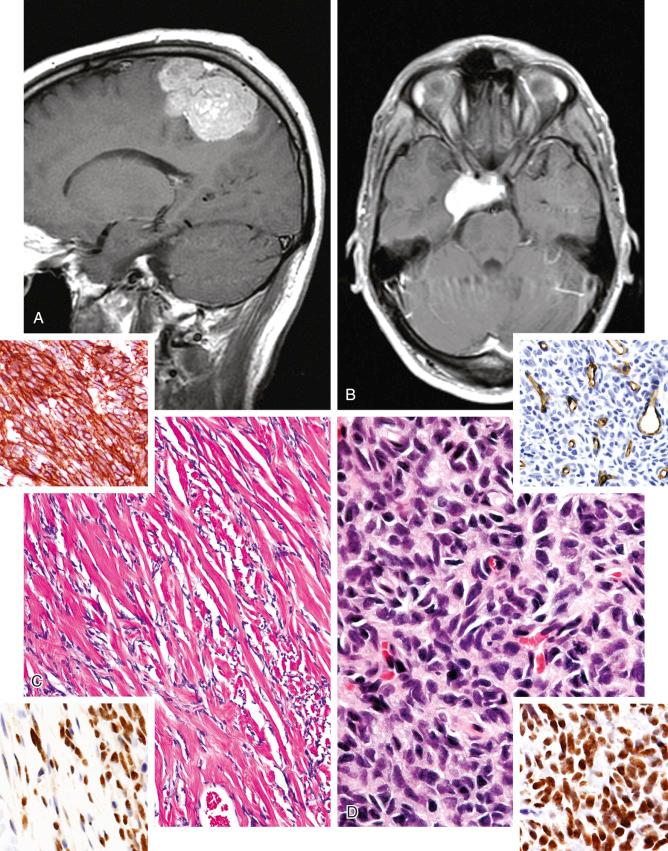 FIGURE 14-14, Solitary fibrous tumor/hemangiopericytoma: radiographic and microscopic features.