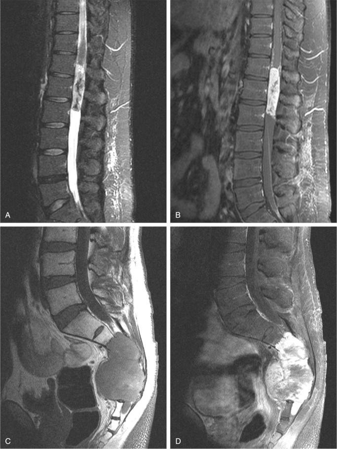 FIGURE 14-16, Myxopapillary ependymoma: radiographic features.