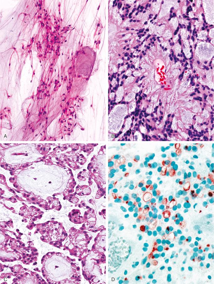 FIGURE 14-17, Myxopapillary ependymoma: microscopic features.