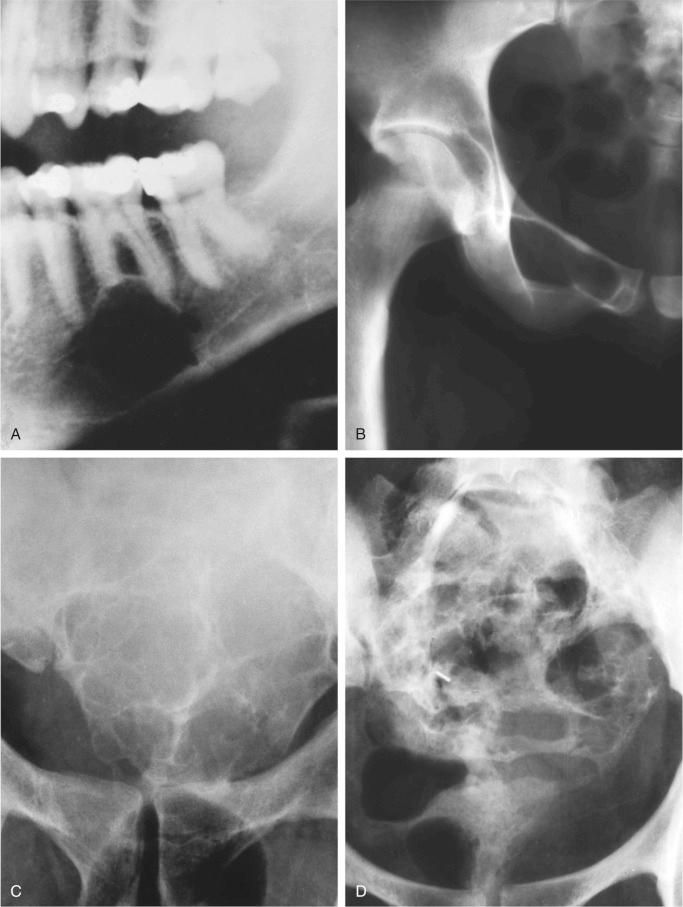 FIGURE 14-18, Intraosseous schwannoma: radiographic features.