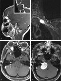 FIGURE 14-19, Schwannoma: radiographic features.