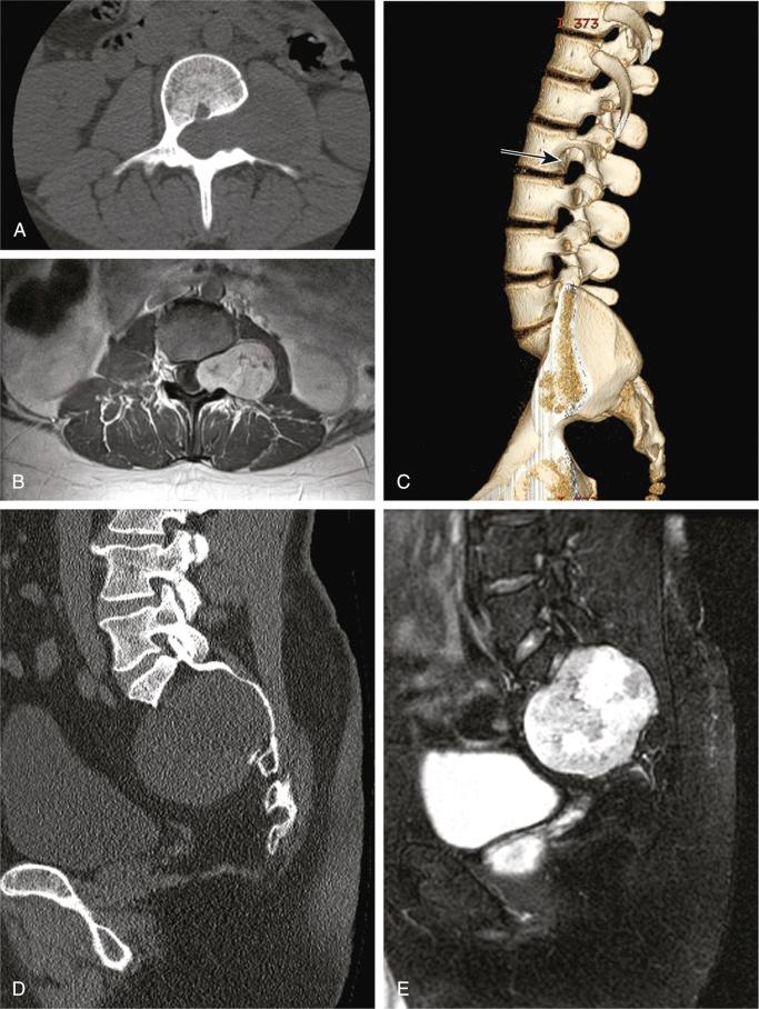 FIGURE 14-20, Schwannoma: radiographic features.